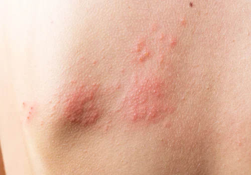 skin-infected-herpes-zoster-virus-herpes-virus-on-2025-01-07-18-21-57-utc